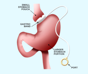 Gastric Lap Band